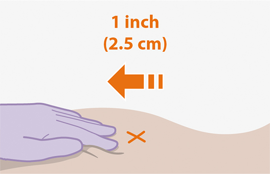 Infographic depicting a medical professional stretching a patients skin.